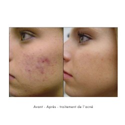 traitement de l'acné mésothérapie needling avant-après